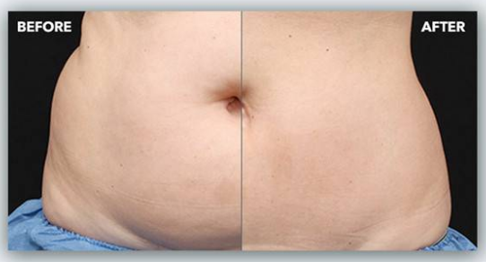 What Is Coolsculpting and How Can It Help You?
