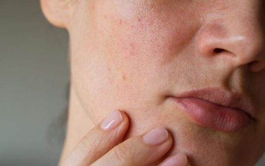 What acne products work for your face and why?